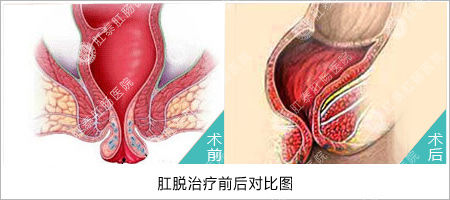 脱肛的症状是什么