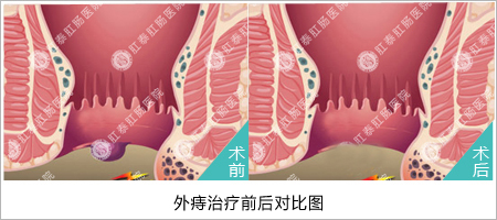 无痛,将脱出肛门的痔疮拉回原位,同时截断向痔疮提供血液的血管,不