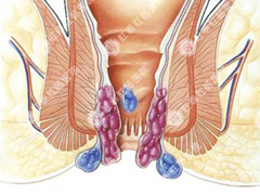 痔疮的症状有哪些
