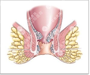 专业治痔疮医院肛泰好不好
