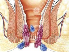 肛肠吻合器的手术治疗痔疮费用