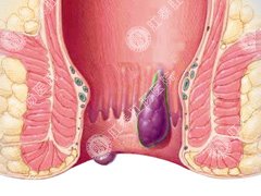 无锡治疗痔疮多少钱